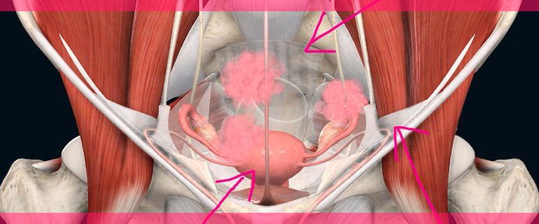 endometriosis