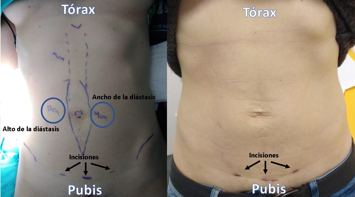 Tratamiento para diástasis abdominal 