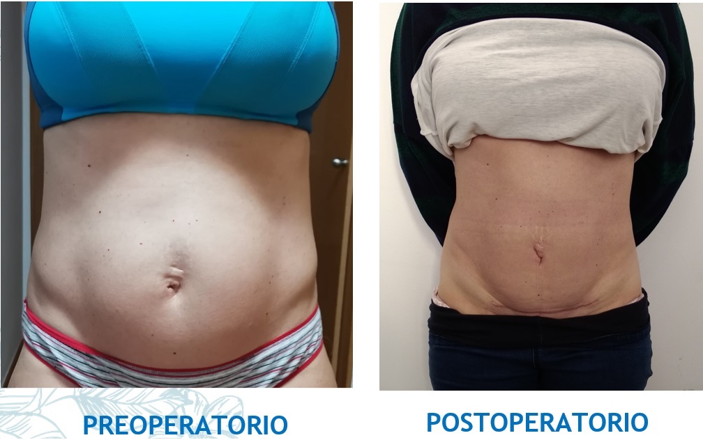 tratamiento diastasis abdominal
